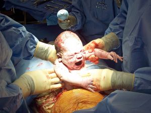 Baby born by Cesarean
